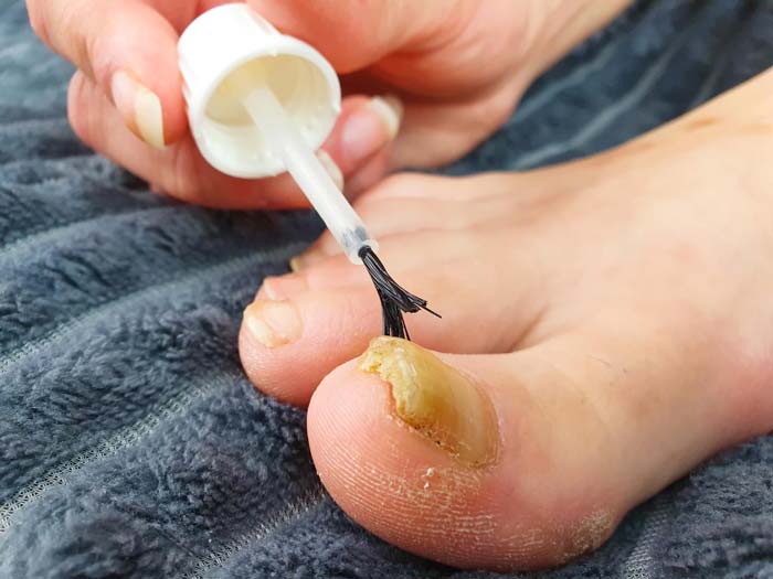 Tratamiento de uñas con hongos en Móstoles