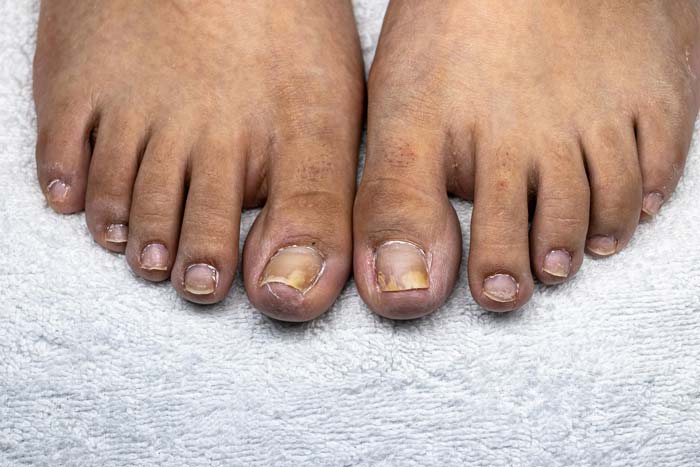 Tratamiento de uñas con hongos en Móstoles