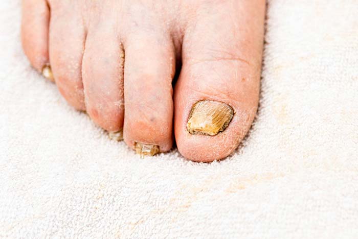 Tratamiento de uñas con hongos en Móstoles