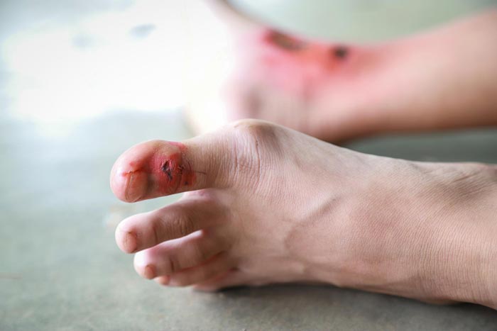 Pie diabético en Móstoles | Prevención y cuidado podológico