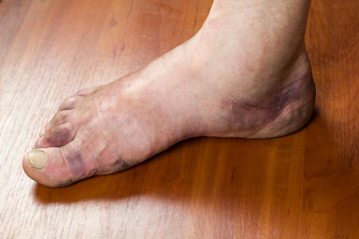 Pie diabético en Móstoles | Prevención y cuidado podológico